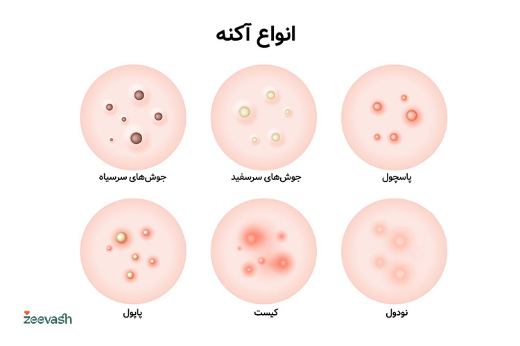 انواع آکنه